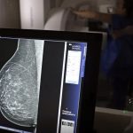 falta-de-acesso-a-mamografos-l