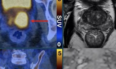 exame-que-faz-as-celulas-do-ca